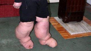 Fil hastalığı nedeniyle 130 kiloya ulaştı