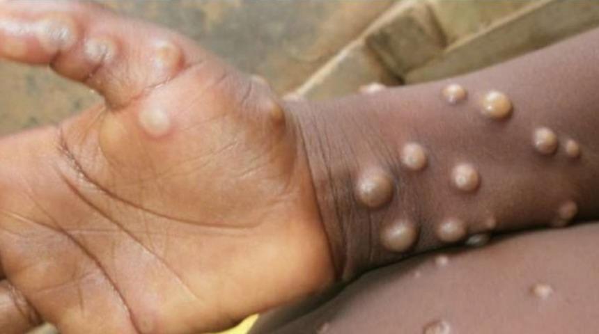 Maymun &Ccedil;i&ccedil;eği vir&uuml;s&uuml; belirtileri neler, &ouml;ld&uuml;r&uuml;r m&uuml;? Maymun &Ccedil;i&ccedil;eği vir&uuml;s&uuml; nasıl bulaşır?