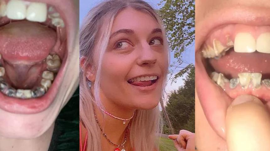 23 yaşında tüm dişleri döküldü! Yaptığı en büyük hatayı hepimiz yapıyoruz