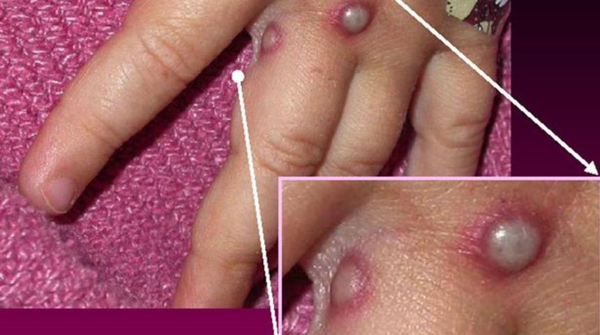 SON DAKİKA | Korkulan oluyor: Maymun çiçeği virüsü 4 ülkeye daha sıçradı