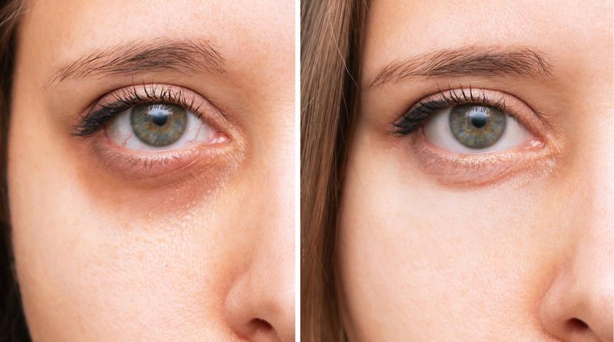 Basit bir cilt problemi olmayabilir! Gözaltındaki mor halkalara dikkat