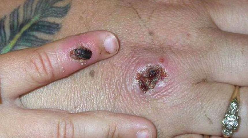 Maymun çiçeği hastalığı dalga dalga yayılıyor! Nedenini bulmak için bütün ülke teyakkuza geçti