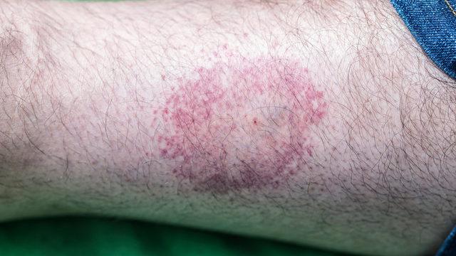 Sessiz pandemi lyme hastalığı ciddiye alınmıyor! Kenelerden bulaşıyor: Her geçen gün sayı artıyor