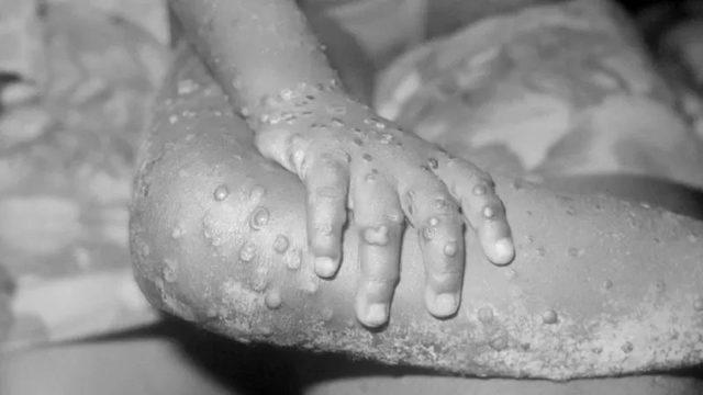 Liberya'da maymun çiçeği virüsüne yakalanan 4 yaşındaki bir kız çocuğunun elleri ve bacakları