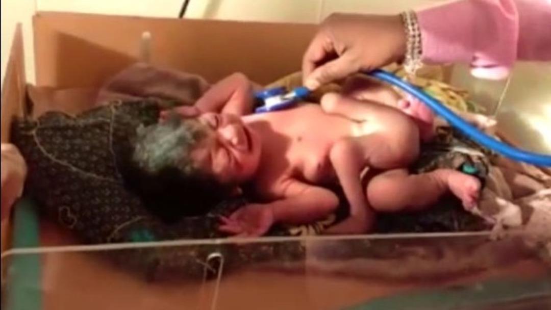 D&ouml;rt bacaklı, iki penisli bebek doğdu!