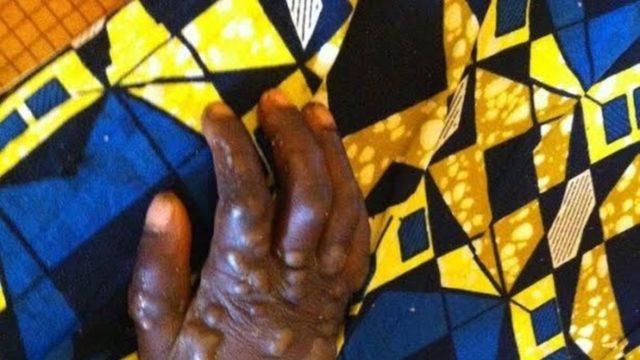 Dünya Sağlık Örgütü'nden Acil Maymun Çiçeği Toplantısı