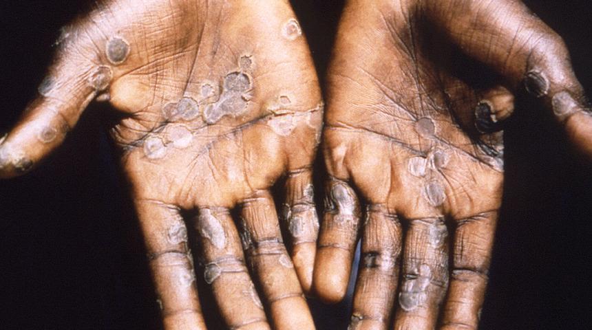 Son dakika... Maymun &ccedil;i&ccedil;eği alarmı! DS&Ouml; teyakkuza ge&ccedil;ti: Acil toplanma kararı aldılar