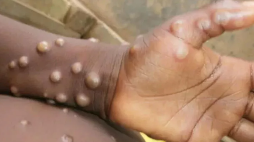 SON DAKİKA | Sayı her geçen dakika artıyor! İki ülkede daha maymun çiçeği virüsü görüldü