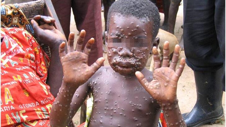 Maymun çiçeği virüsü nedir, nasıl bulaşır? Maymun Çiçeği hastalığı tedavisi var mı? Belirtileri nelerdir? G2