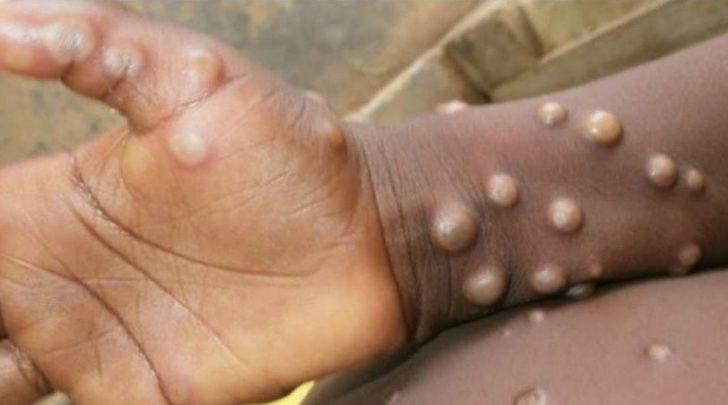 Maymun çiçeği virüsü nedir, nasıl bulaşır? Maymun Çiçeği hastalığı tedavisi var mı? Belirtileri nelerdir? G4