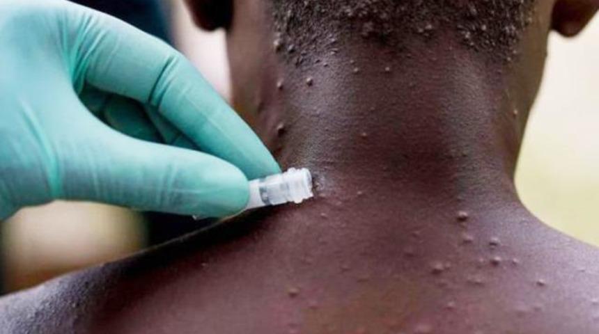 Maymun çiçeği virüsü Türkiye'ye geldi mi? Maymun çiçeği virüsü belirtileri nelerdir? Maymun çiçeği virüsü Türkiye'de var mı?