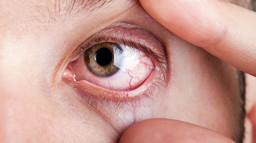 Dikkat! Gözlerin bu şekilde görünmesi kanser habercisi olabilir