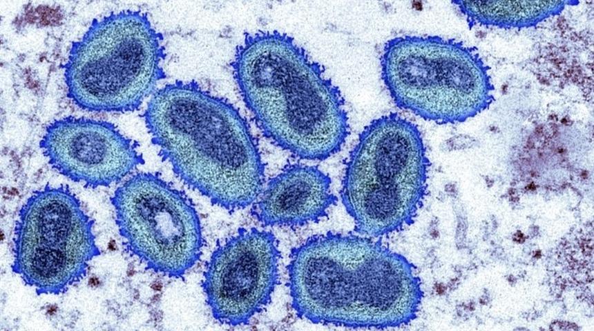 Maymun çiçeği virüsü: Birleşik Krallık'ta vaka sayısı 82'ye çıktı