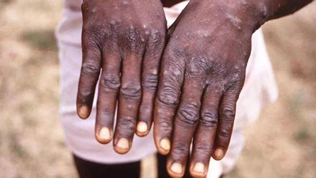 Maymun &ccedil;i&ccedil;eği vir&uuml;s&uuml; T&uuml;rkiye'de g&ouml;r&uuml;ld&uuml; m&uuml;? Maymun &Ccedil;i&ccedil;eği vir&uuml;s&uuml; nedir, nasıl bulaşır, hangi &uuml;lkelerde g&ouml;r&uuml;ld&uuml;?