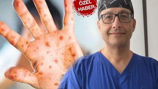 Herkesin merak ettiği soruyu cevapladı: Maymun çiçeği virüsü öldürüyor mu? Dünyayı panikleten Maymun çiçeği virüsünün belirtileri...