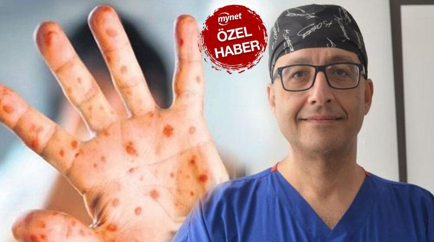 Herkesin merak ettiği soruyu cevapladı: Maymun çiçeği virüsü öldürüyor mu? Dünyayı panikleten Maymun çiçeği virüsünün belirtileri...