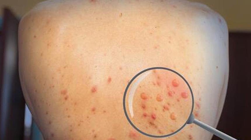 Türü önemli değil! Maymun çiçeği virüsüyle cinsel ilişki...