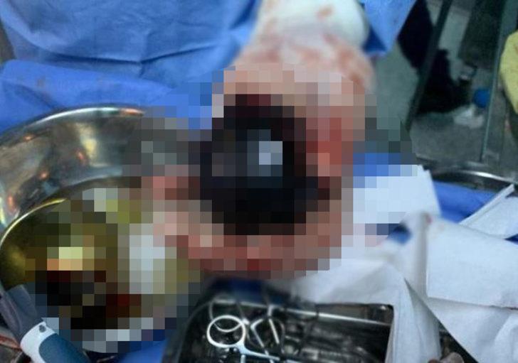 “Basur tedavisi için” dedi! Makatında plastik top sıkışan adam, 7 saatlik operasyonun sonucunda kurtarıldı