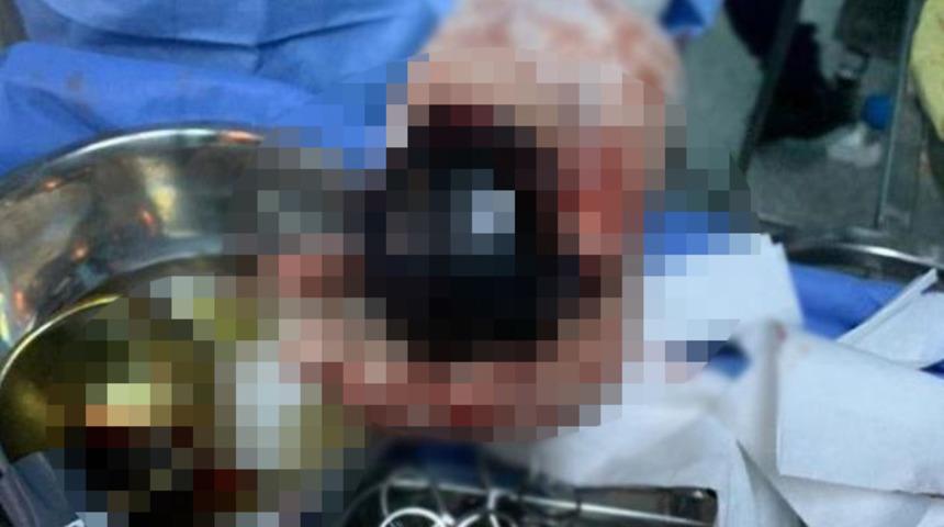 “Basur tedavisi için” dedi! Makatında plastik top sıkışan adam, 7 saatlik operasyonun sonucunda kurtarıldı