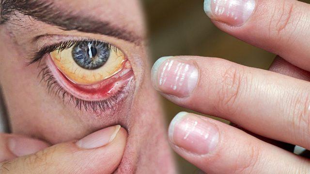 Doktora gitme vaktinizin geldiğini gösteren belirtiler! Demir eksikliği nedir, demir eksikliği belirtileri nelerdir?