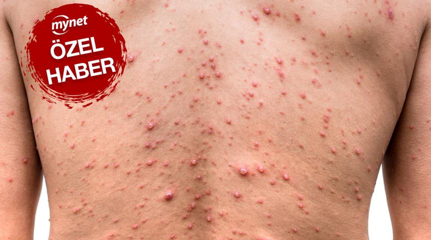 Maymun çiçeği virüsünün Türkiye’de görülme ihtimali...