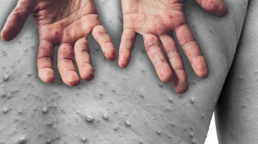 Uşak'ta 'maymun çiçeği virüsü' paniği! Sağlık Müdürlüğü'nden açıklama geldi: 'Kabarcıklar görülmesi üzerine...'