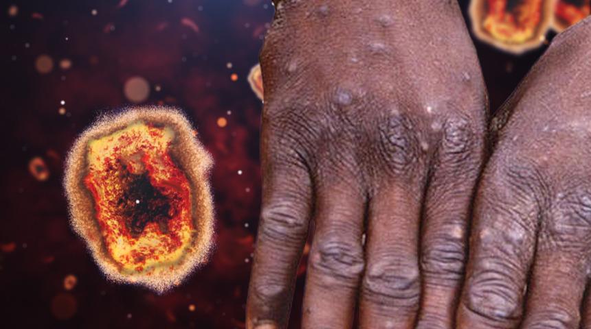 DSÖ'den flaş açıklama! Maymun çiçeğinde vaka sayıları yükseliyor... Herkesin merak ettiği soruya yanıt: Can kaybı yaşandı mı?