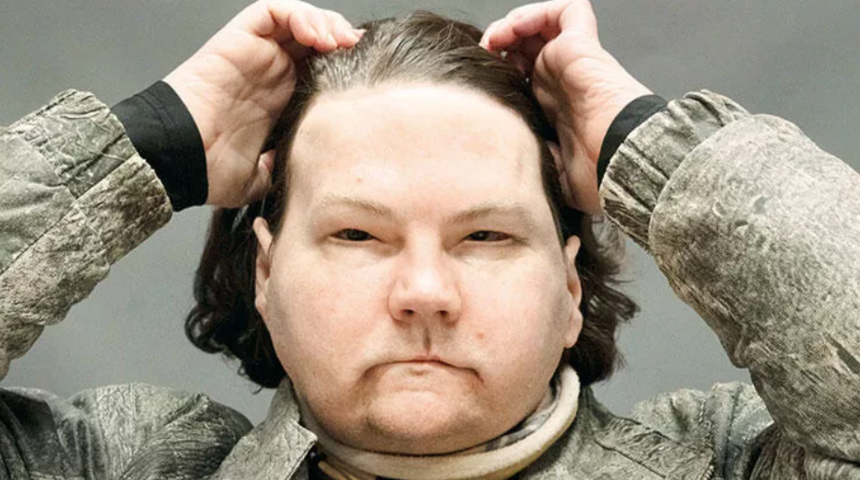 Dünyada ilk kez! Eş zamanlı çift el ve yüz nakli oldu: Herkes bana bakıyor