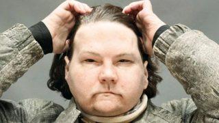 Dünyada ilk kez! Eş zamanlı çift el ve yüz nakli oldu: Herkes bana bakıyor