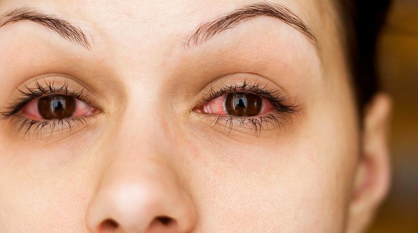 Görme kaybı yaşayabilirsiniz! Göz kaşıntınız varsa…