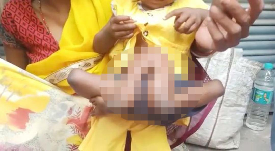 Doktorlar bile şaşırdı! Beline bağlı iki kol ve bacakla doğdu
