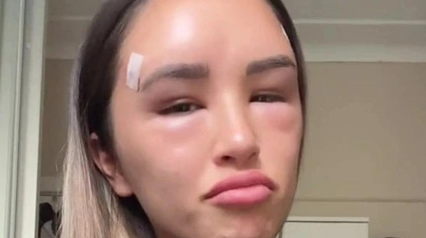 Estetik kurbanı oldu! ''En büyük pişmanlığım'' dedi