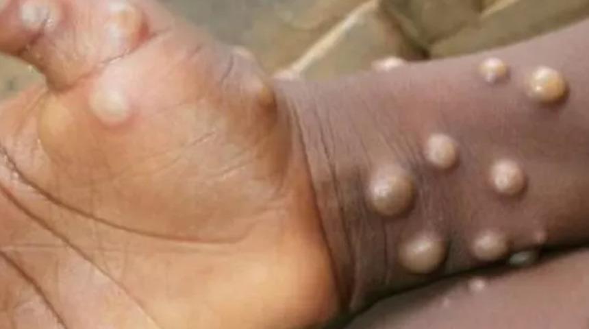 DSÖ'den maymun çiçeği açıklaması... Salgına dönecek mi?