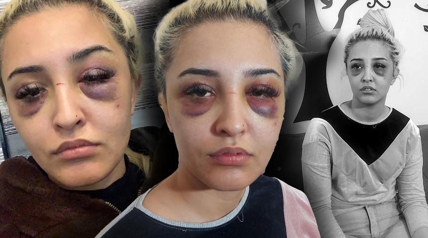 Eski sevgilisi tanınmaz hale getirmişti! Şok gelişme: Şikayetini geri çekti