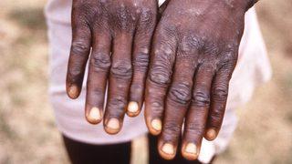 Maymun çiçeği virüsü: 'Kabus değil ama kötü bir rüya olabilir'