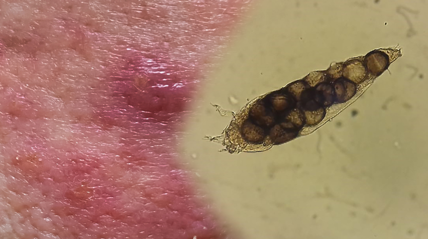 Yıkamayla geçmiyor, temasla bulaşıyor! Cilde yapışıp kalıyor