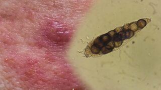 Yıkamayla geçmiyor, temasla bulaşıyor! Cilde yapışıp kalıyor