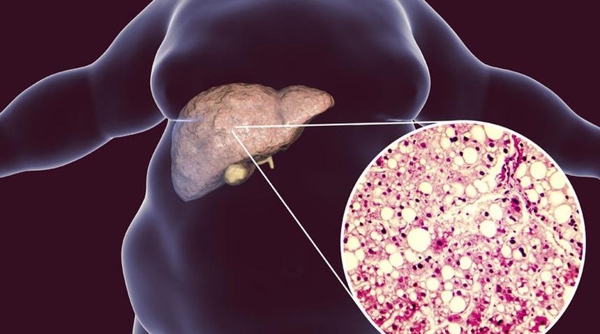 Belirti vermiyor, sinsi ilerliyor, henüz ilacı yok ve ölümcül olabilir! Karaciğerin gizli düşmanı: NASH