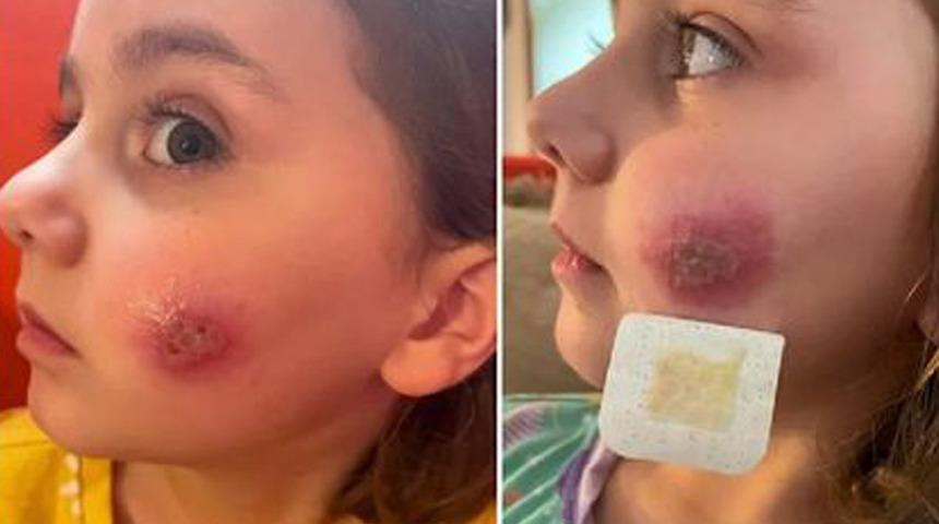 Annesinin hatası onu bu hale getirdi! Günlerce hastanede kaldı