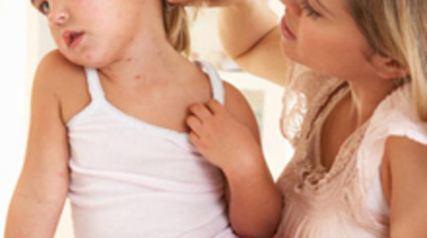 &Ccedil;ocukluk alerjileri yaşamı etkiliyor