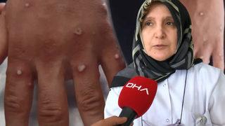 İstanbul'da maymun çiçeği virüsü paniği! Yetkililer hemen harekete geçti... İki Afgan'a ilaç veren eczacı konuştu: Ellerindeki yaralar...