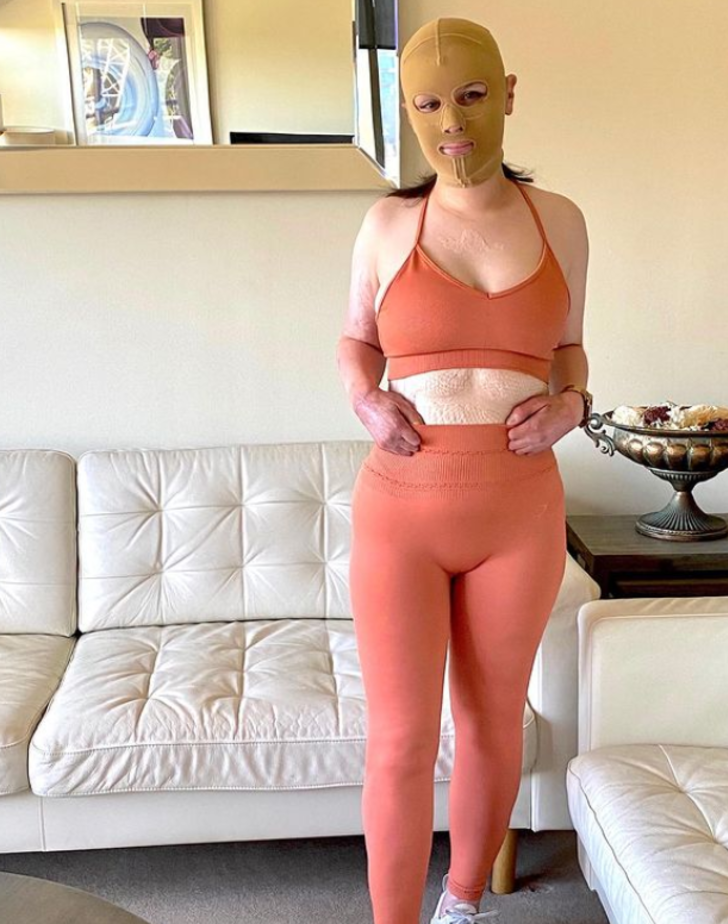 Yanardağ patlamasında vücudunun büyük bölümü yanmıştı! Yıllar sonra maskesini çıkarttı G1