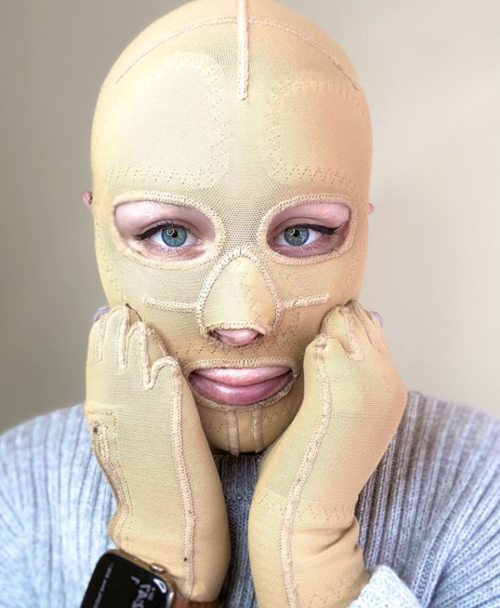 Yanardağ patlamasında vücudunun büyük bölümü yanmıştı! Yıllar sonra maskesini çıkarttı G2