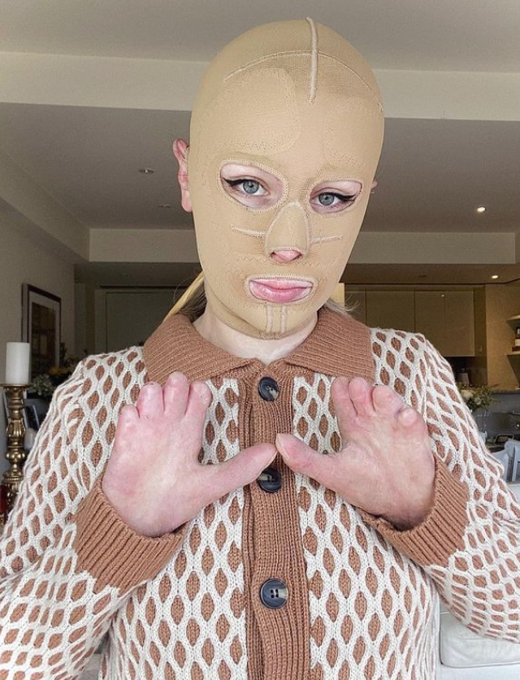 Yanardağ patlamasında vücudunun büyük bölümü yanmıştı! Yıllar sonra maskesini çıkarttı G3