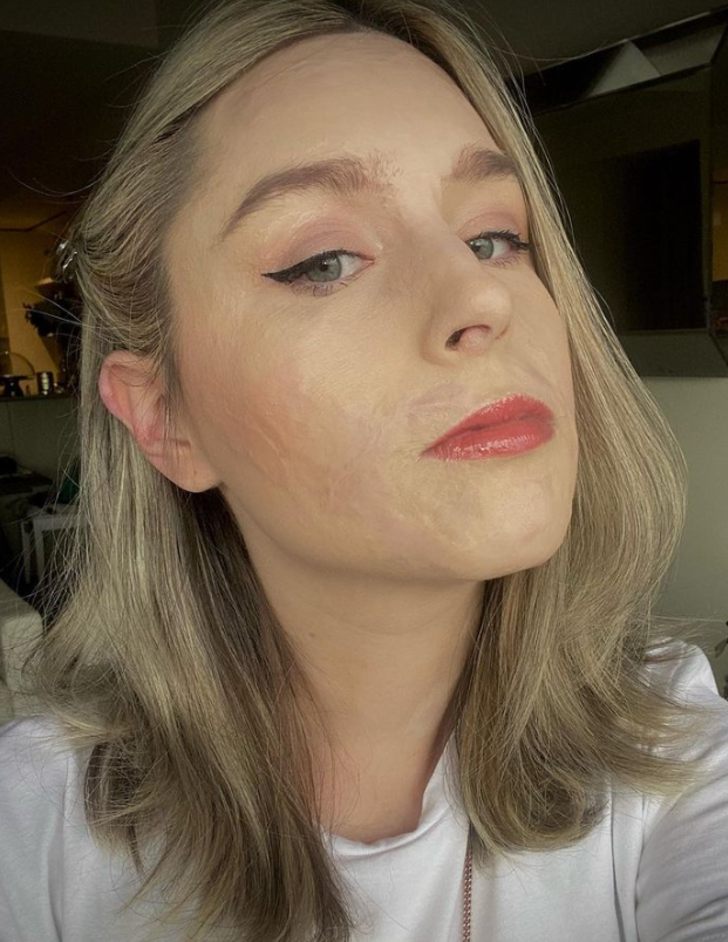 Yanardağ patlamasında vücudunun büyük bölümü yanmıştı! Yıllar sonra maskesini çıkarttı G5