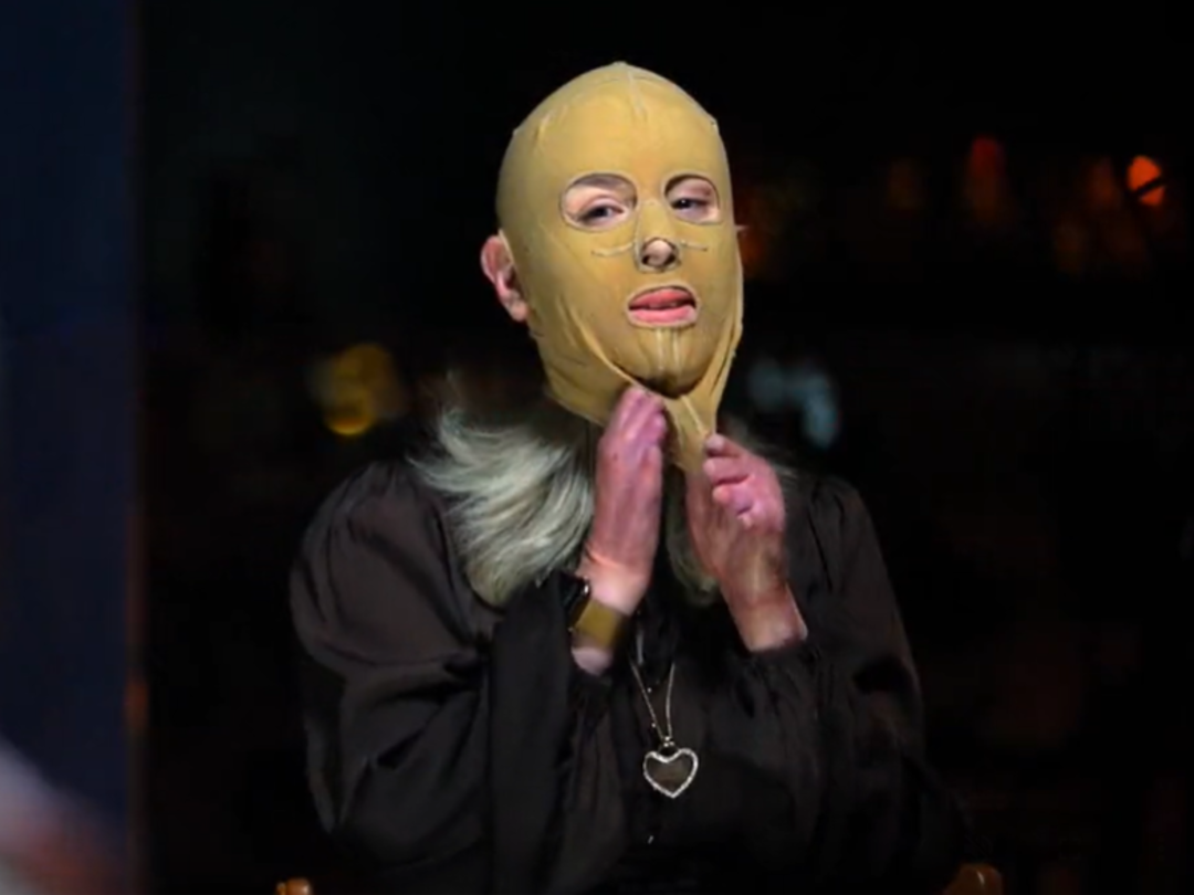 Yanardağ patlamasında v&uuml;cudunun b&uuml;y&uuml;k b&ouml;l&uuml;m&uuml; yanmıştı! Yıllar sonra maskesini &ccedil;ıkarttı