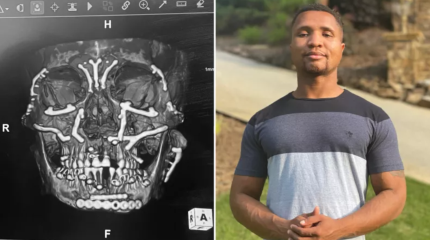 3. kattan çenesinin üzerine düştü: Yüzündeki kemikler paramparça oldu! 3D baskıyla yüzünü topladılar! Son hali inanılmaz