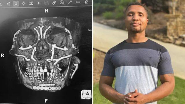 3. kattan çenesinin üzerine düştü: Yüzündeki kemikler paramparça oldu! 3D baskıyla yüzünü topladılar! Son hali inanılmaz