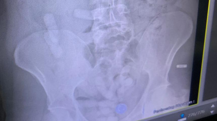 İranlı yolcu yakayı ele verdi! Midesinden 15 paket uyuşturucu çıktı