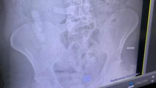 İranlı yolcu yakayı ele verdi! Midesinden 15 paket uyuşturucu çıktı